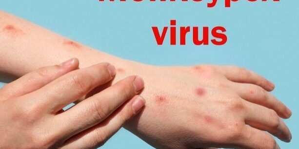 Gejala Mpox 