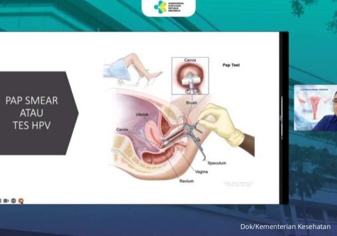Mempercepat Eliminasi Kanker Serviks