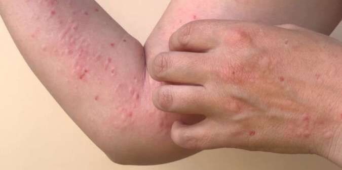Monkeypox tahun 2023 ditemukan di wilayah DKI Jakarta

