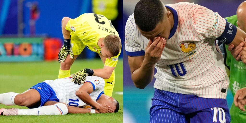 Kylian Mbappe cedera patah tulang hidung