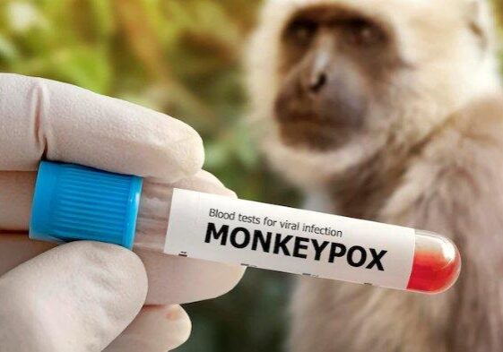 Monkeypox atau cacar monyet - Di dalam surat edaran tersebut, Kemenkes mengingatkan agar tidak hanya mewaspadai penularan antar manusia. 


