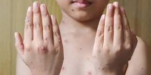 Ciri-ciri terpapar virus cacar monyet atau Mpox.